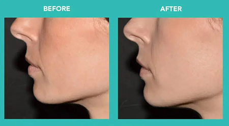 รีวิว Belotero Revive